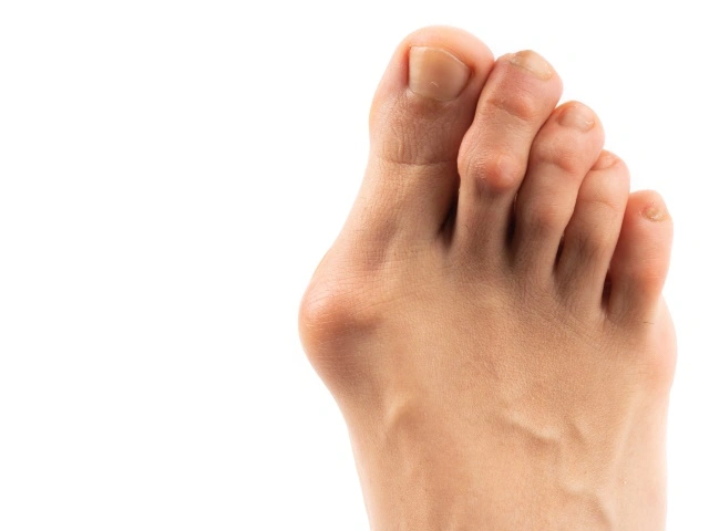 Halluks Valgus
