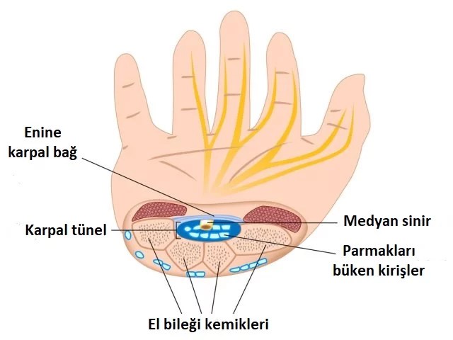 Karpal Tünel Sendromu önceden bilinebilir&nbsp;mi?